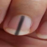 Image result for Acral lentiginous melanoma nail