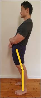 Those who suffer from hyperextended knee will feel severe pain that requires a medical professional to identify and treat the problem. Exercises For Hyperextended Knees Posture Direct