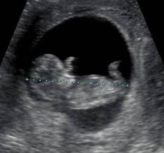 Having the scan does not hurt, but the sonographer might need to apply slight pressure to get clear views of your baby. Normal 1st Trimester Ultrasound How To