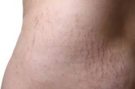 In Medical Terms Blackheads Are Called Open Comedones And They Are Nothing But Larger Follicles Op Stretch Marks Stretch Mark Remedies Oil For Stretch Marks