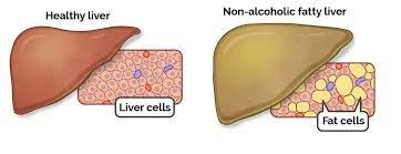 Nonalcoholic Fatty Liver Disease - Symptoms, Treatment, Diet