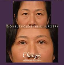 Doublefold Eyelid Surgery Eyelid Surgery Body Plastic Surgery Plastic Surgeon