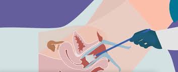 Image result for Cervical Cancer Screening