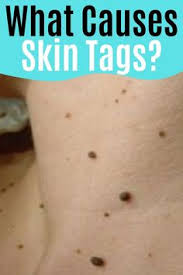It's not uncommon to always. 17 Skin Tag Info Ideas Skin Tag Skin Skin Tag Removal