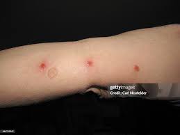 Image result for Cimex lectularius bites