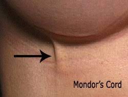 Penile mondor's disease is a thrombophlebitis of the superficial dorsal vein of the penis. Mondor Disease Www Medicoapps Org