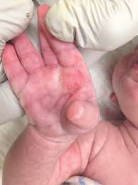 It is usually asymptomatic, and when present, is often in the context of a known medical problem such as liver disease, connective tissue disease, or an endocrinopathy such as graves. What Explains This Newborn S Palmar Rash Consultant360