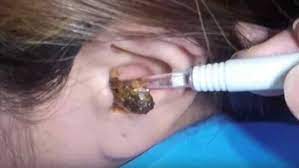 I am looking for a way to encourage the removal of dried earwax from my 6 year old son's ears. Earwax Removal Videos Are The New Pimple Popping Sensation