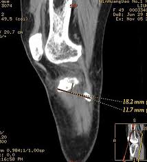 Image result for Segond Fracture