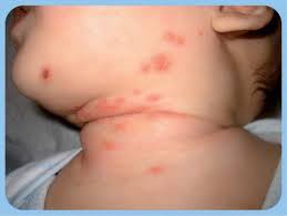 It is common that viruses can cause skin rashes, but what is unusual about the rashes in the rash looked similar to chicken pox but with smaller, less itchy pimples. Characterizing Viral Exanthems Pediatric Health