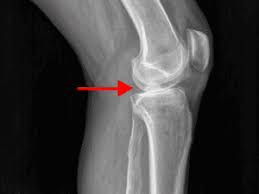 Image result for Knee XRay