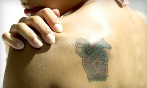 The body then absorbs these ink fragments and naturally eliminates them. Medermis Tattoo Removal Specialists In Austin Texas Groupon