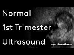 Image result for First Trimester Ultrasound