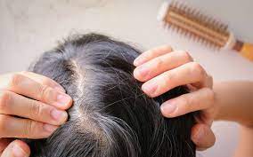 La longueur accentuera davantage le manque de densité capillaire et vous risquez de vous retrouver avec un dessus de tête clairsemé. Comment Eviter La Chute De Cheveux