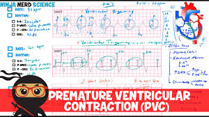 Premature ventricular contraction premature ventricular contractionclassification & external resources premature ventricular contraction in an ecg (arrows). Rate And Rhythm Premature Ventricular Contraction Pvc Youtube