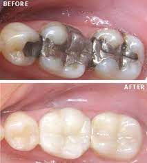 Tooth Coloured Filling Is Used To Repair A Tooth That Is Affected By Decay Cracks Fractures Fillings Dental Fillings Dentistry Dental Implants