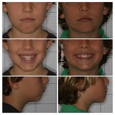Palate expansion with Biobloc for 8 year old: 9 week progress Feeling proud  of this remarkable facial change accomplished in a relatively short period  of time. I was very surprised to see