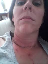 I had SDR a little over a year and a half ago 😁