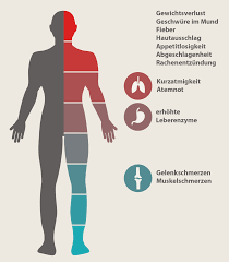 Hiv Symptome Typische Anzeichen Erkennen Was Tun