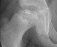 This affects the epiphysis of the femur, which is the bone distal to the growth plate (physis). Calve Legg Perthes Krankheit Deximed