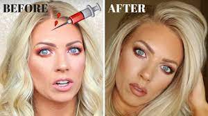 Unless you get another injection, spasticity will return. Botox My Experience Before After Pictures Youtube