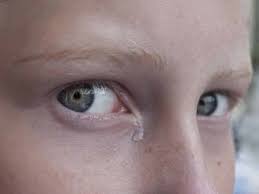 Verstopfter Riss Was Es Ist Symptome Und Behandlung Area Oftalmologica