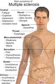 How to use ms in a sentence. Multiple Sclerosis Ms