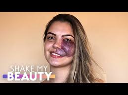 I Thought I'd Never Find Love With My Birthmark