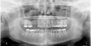 Image result for Tooth Attrition