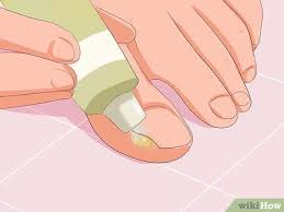 Maybe you would like to learn more about one of these? Comment Soigner Une Infection A Un Ongle Incarne