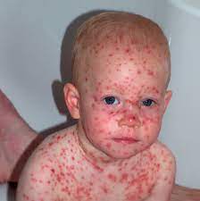 Varicella, also commonly referred to as chickenpox, is an acute and highly contagious disease. Varicella Chickenpox Immunisation Advisory Centre
