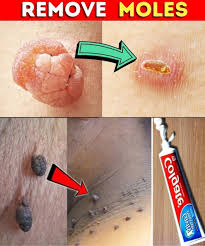 Recipe for removing plantar warts and skin tags