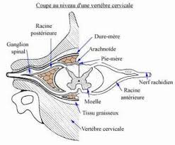 Les kystes méningés (tarlov et variants) sont des excroissances de l'arachnoïde remplies de fluide cerebro spinal, que l'on trouve le plus souvent au niveau sacré par l'intermédiaire d'une irm. Article Sur Ma Putain D Affection Neurologique Article Ecrit Par Le Dr Sarah Jones Medecin Australienne Touchee Elle Meme Par Cette Maladie Blog De Romaideckriistaill