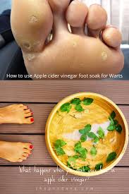 Baking soda is another great home remedy for toenail fungus. Apple Cider Vinegar Foot Soak What Happens If You Soak Your Feet In Acv Shopno Dana