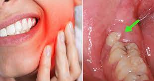 Orang yang sakit gigi akan merasakan sakit yang luar. Tak Tahan Gigi Geraham Sakit 5 Bahan Semula Jadi Ini Bantu Redakan Sakit Dengan Segera Vanilla Kismis