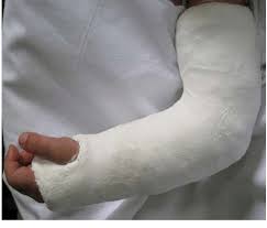 Image result for Long Arm Cast