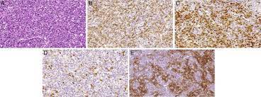 Angioimmunoblastic t cell lymphoma (aitl) presents in older patients and the median age at diagnosis is approximately 60. Morphologic Aspects Of Angioimmunoblastic T Cell Lymphoma A Download Scientific Diagram