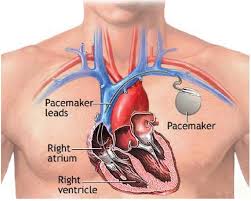 An implantable cardioverter defibrillator (icd) looks similar to a pacemaker, though slightly larger. Pacemakers Defibrillators Center For Advanced Cardiac And Vascular Interventions