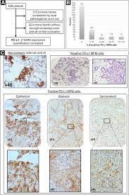 Mesothelioma info, help for veterans Shorter Survival In Malignant Pleural Mesothelioma Patients With High Pd L1 Expression Associated With Sarcomatoid Or Biphasic Histology Subtype A Series Of 214 Cases From The Bio Maps Cohort Clinical Lung Cancer
