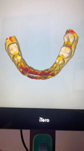 Can’t get enough of beginning and end comparisons using @iteroscanner  TimeLapse! , #timelapse #invisalign #digitaldentistry #clearaligners  #queens #itsinqueens #jacksonheights #itero