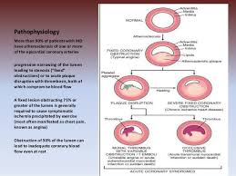 Rehospitalization rates for mi and stroke as well as the composite end point between stemi and nstemi patients were as follows: Acute Coronary Syndrome Nstemi