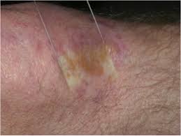 Image result for Diascopy