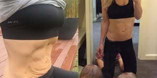 Some alternative procedures are also available, but not as effective. This Photo Shows That Loose Skin Is Normal After Giving Birth Even If You Have A Six Pack Self