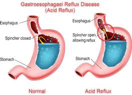 Unfortunately, it can do it. Why Seniors Get Heartburn Acid Reflux And Tips On How You Can Manage Yours Eldercare Home Health Inc