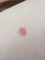 Krasnoe Pyatno Na Noge S Nerovnymi Krayami Ne Cheshetsya Vopros Dermatologu 03 Onlajn