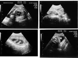 15 Weeks Pregnant Symptoms Bump More Babycenter Places corpus christi, texas medical and healthmedical centrepregnancy care centre bump 2 baby & beyond 4d 5d hd live ultrasounds. 15 weeks pregnant symptoms bump