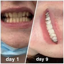 The next step is to apply the strip to your teeth (either the top or bottom row, depending on which strip you chose. Crest 3d Whitestrips Classic White Teeth Whitening Kit 20 Strips Walmart Com Walmart Com