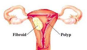 If You Re Not Certain What Uterine Polyp Removal Entails Here S Everything You Need To Know About The Procedure Uterine Polyps Polyp Polyps Uterus