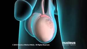 This symptom is not very specific because it happens in many other testicular diseases. Testicular Cancer Youtube