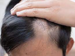 The primary reason delayed allergic reactions can cause hair loss is because of increased immune response. Common Causes Of Hair Loss
